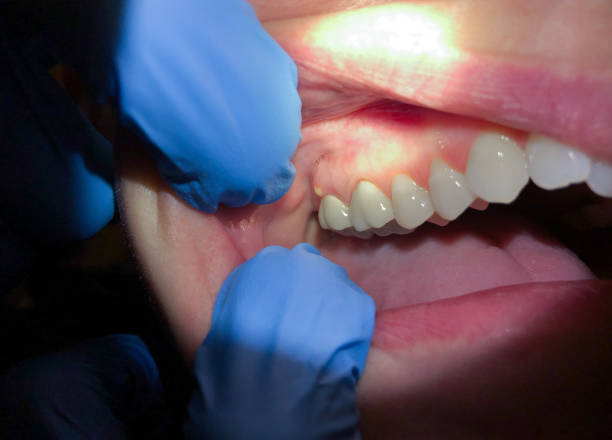 Best Emergency Treatment for Dental Infections or Abscesses in Cape Carteret, NC