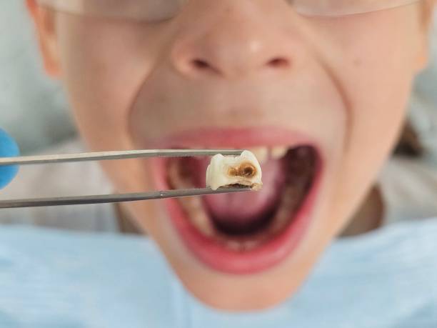 Best Urgent Care for Lost Fillings or Crowns in Cape Carteret, NC
